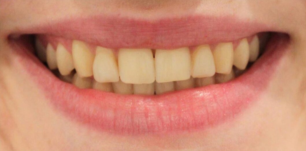 smiling-dental-teeth-whitening-before-after-1 (1) smiling-dental-teeth-whitening-before-after-1 (1)