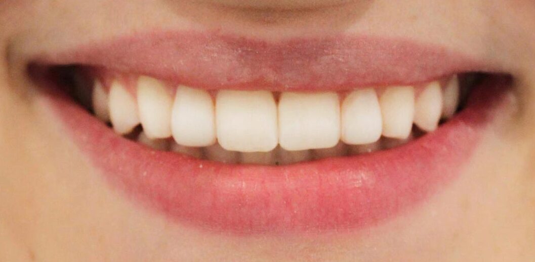 smiling-dental-teeth-whitening-before-after-1 (2) smiling-dental-teeth-whitening-before-after-1 (2)