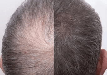 Natura Clinics | Hair Loss Solution Hair Growth Treatment